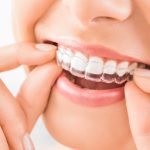 Achieving a Beautiful Smile: How Invisalign Can Help