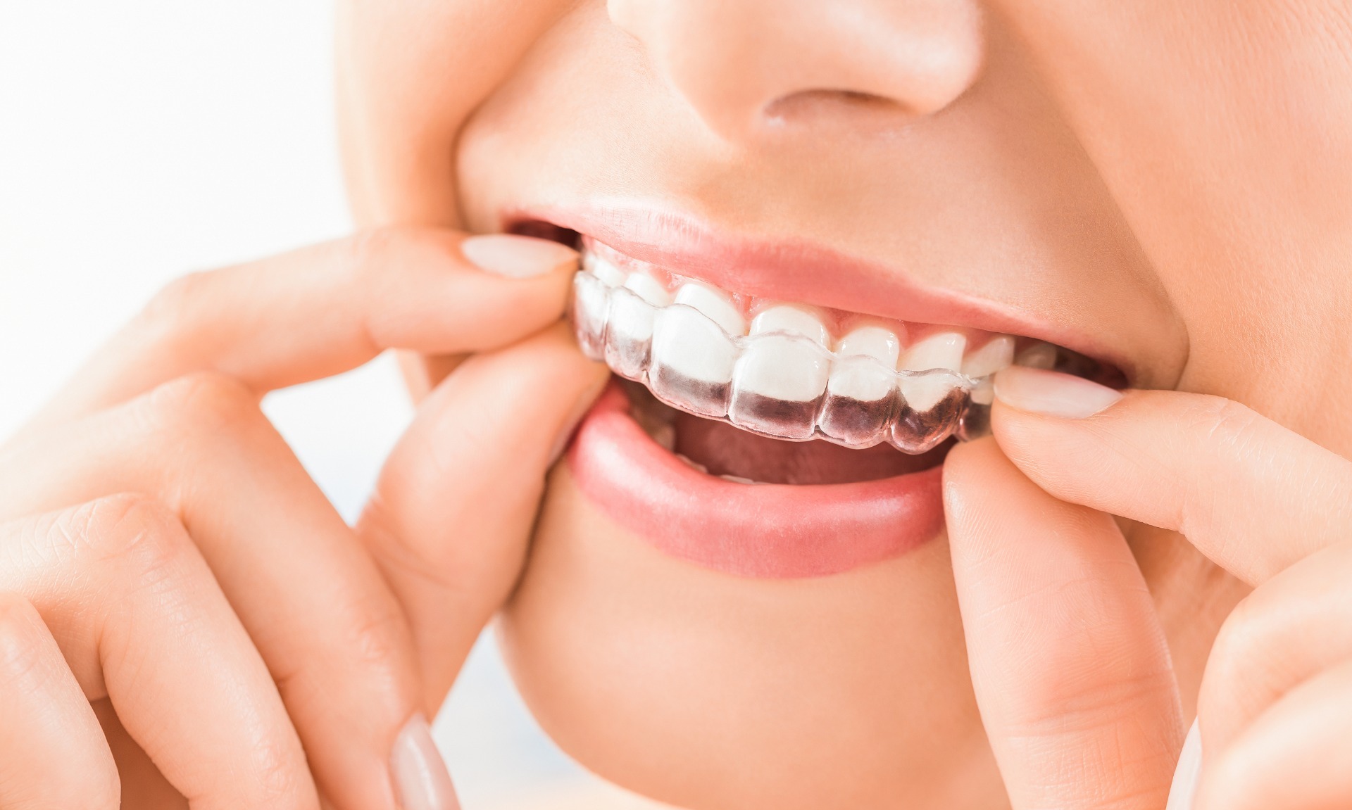 Achieving a Beautiful Smile: How Invisalign Can Help